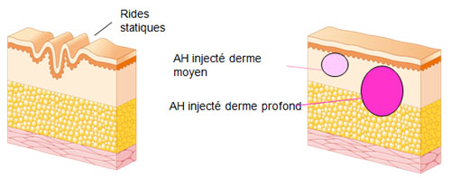 Schéma de l'injection d'acide hyaluronique pour le comblement des rides