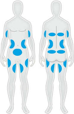 Zones du corps traitées par cryolipolyse